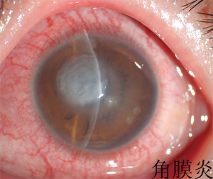 结膜炎和角膜炎有什么不同?临床表现,发病特点,治疗和预后