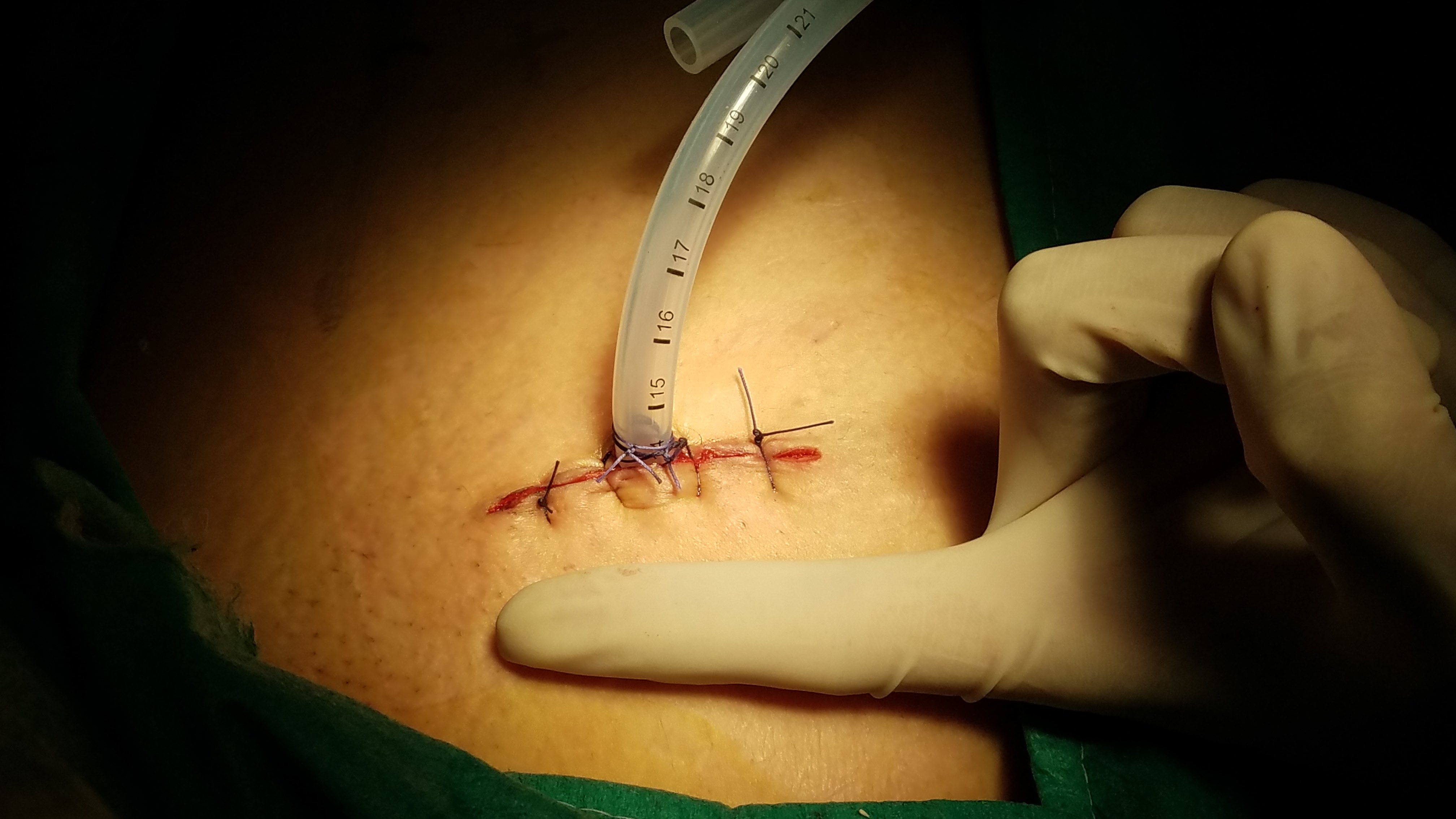 单孔胸腔镜治疗纵隔肿瘤的优势