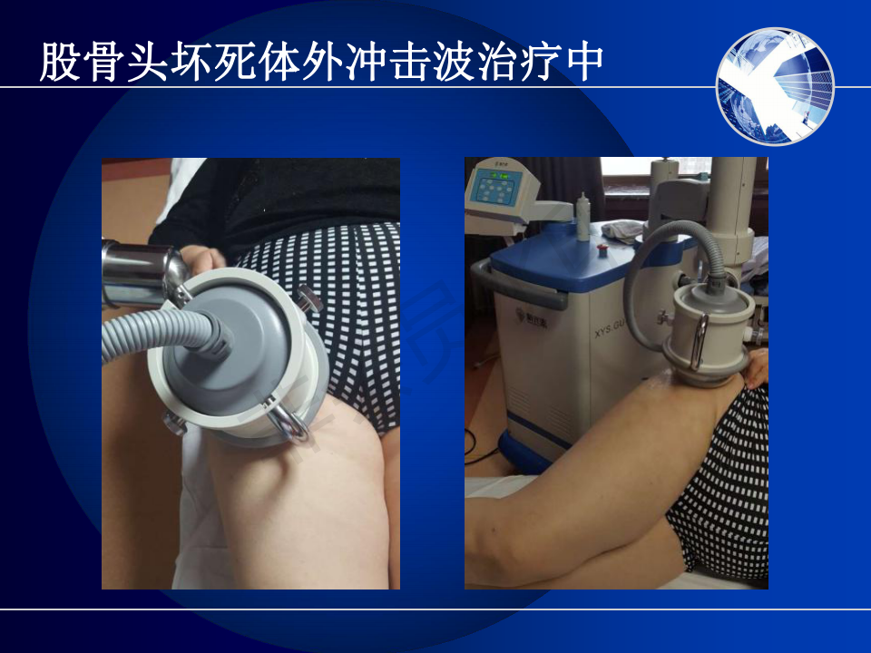 解读骨肌疾病体外冲击波疗法中国专家共识