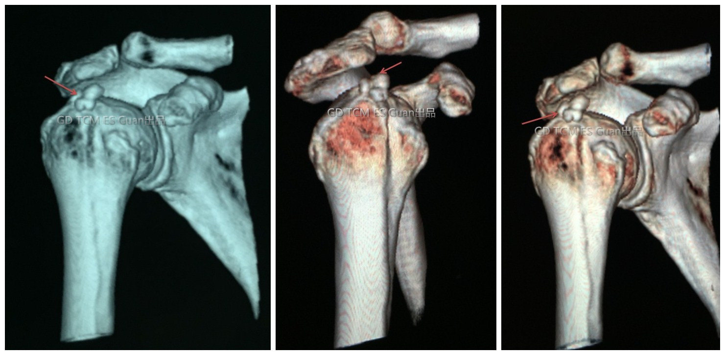肩周炎ct图片