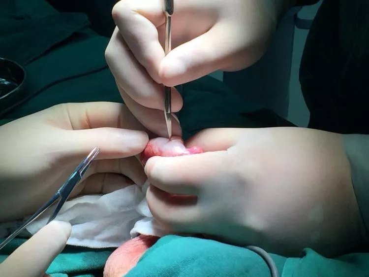 手术进行中2018年4月份开始王先生的妻子进行试管婴儿术前常规检查