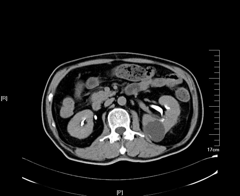 多囊肾CT图片