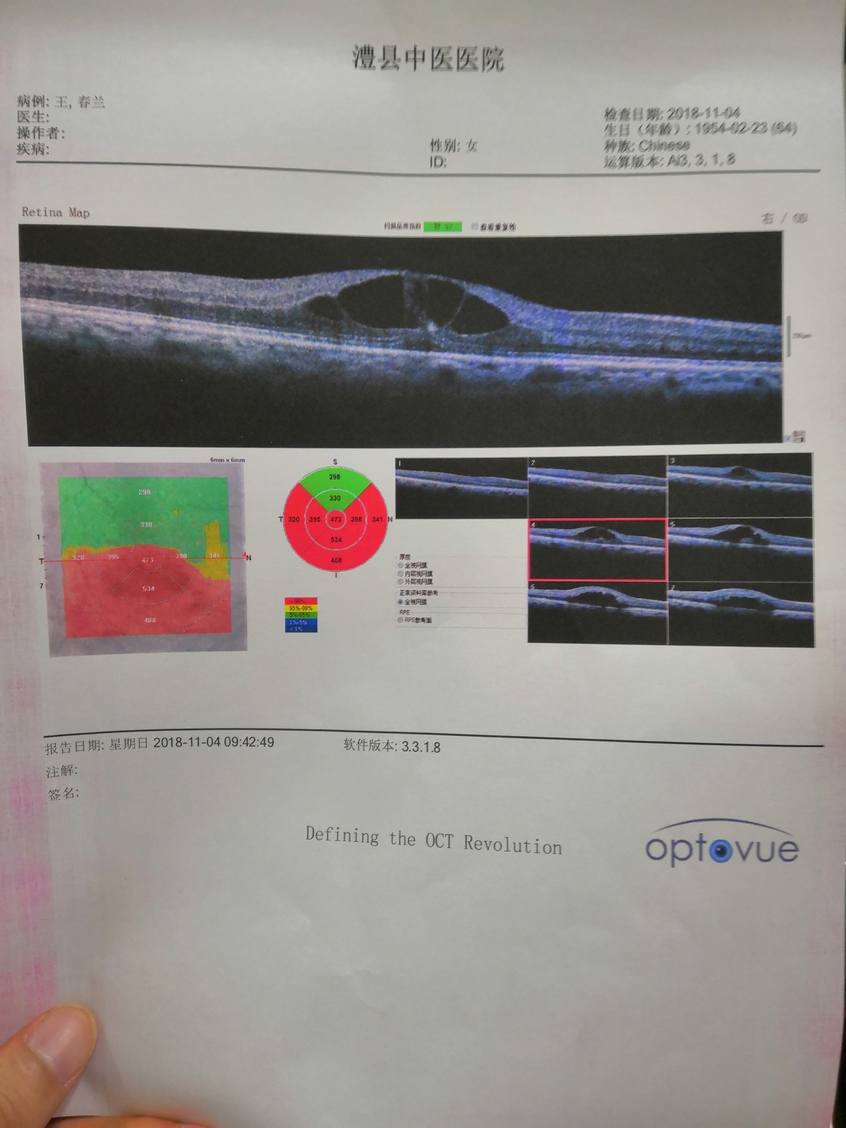 患者右眼oct檢查:黃斑明顯水腫.雙眼眼底熒光血管造影(ffa)結果.