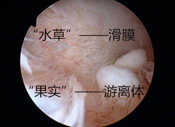 如何理解膝关节游离体