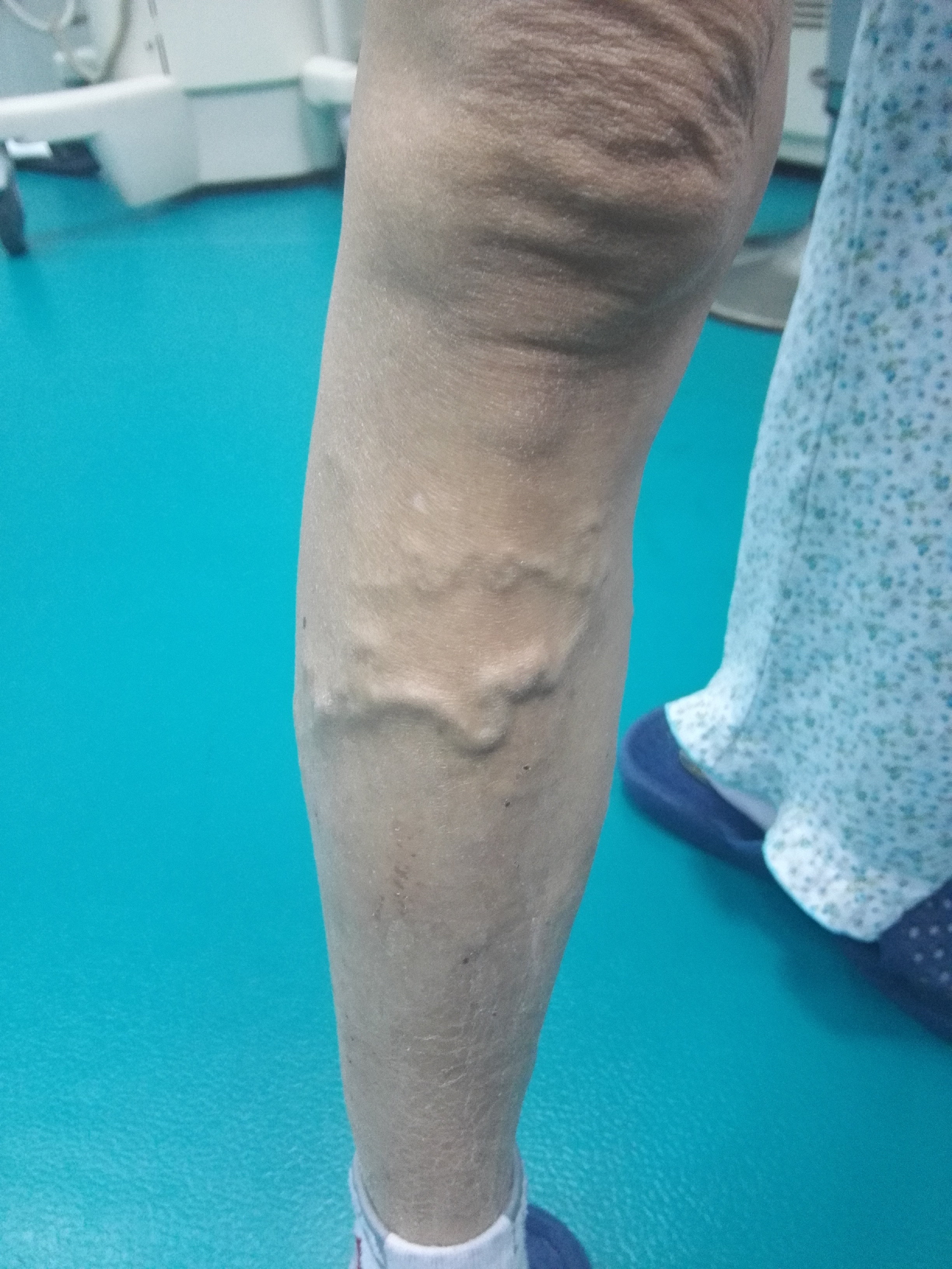 下肢静脉曲张患者的福音～超级微创无痛苦! - 好大夫在线