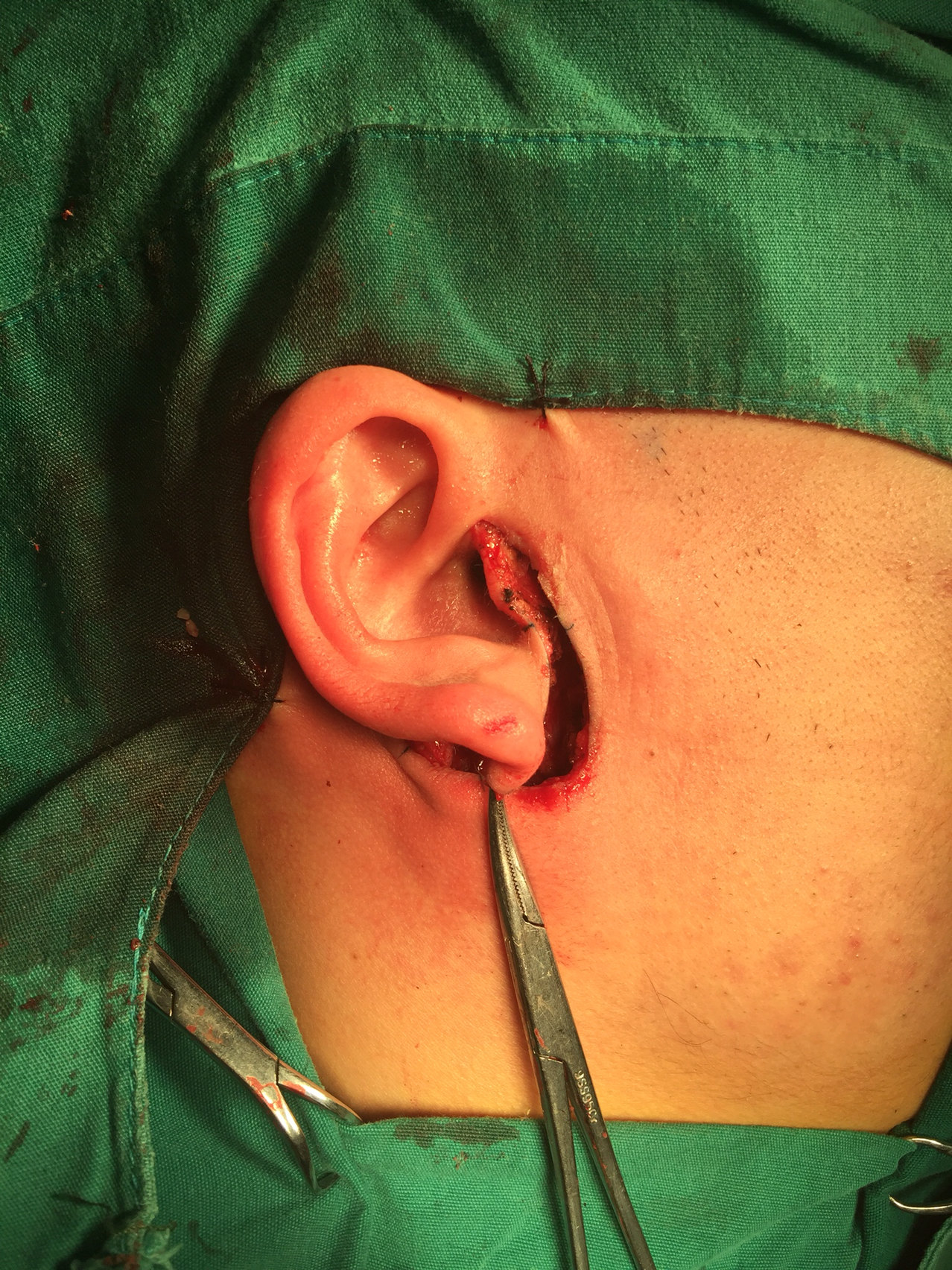 腮腺混合瘤手术图片