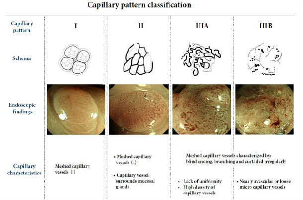 colonoscopy; diagnosis; magnifying endoscopy; narrow band