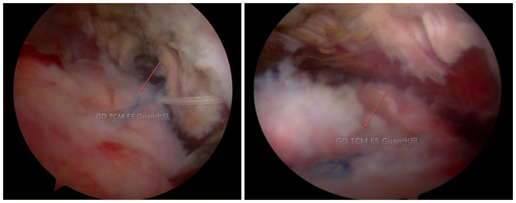 镜下以铆钉修复损伤的冈上肌腱
