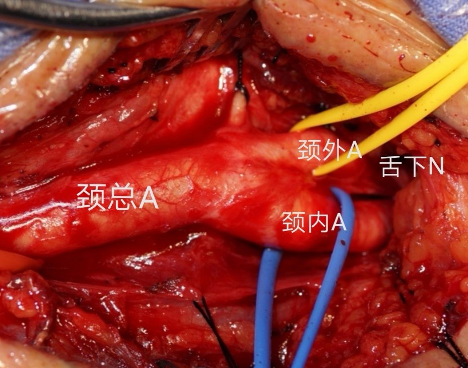 颈总动脉 颈内动脉狭窄串联病变的治疗 - 好大夫在线