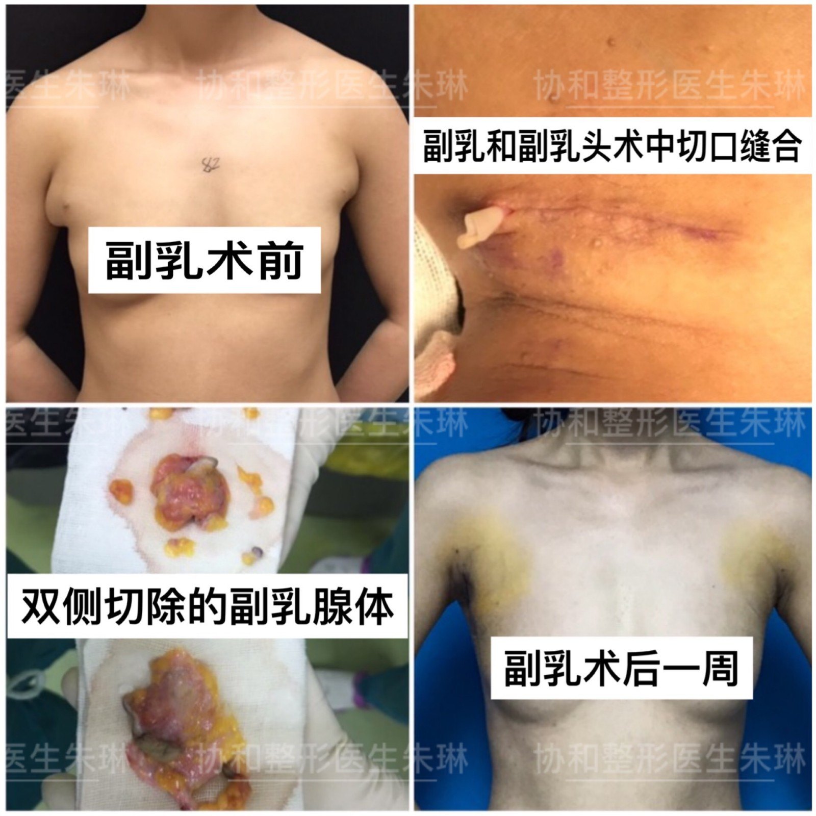 做副乳手术术后瘢痕明显吗 附四组案例对比图 副乳 副乳手术 好大夫在线