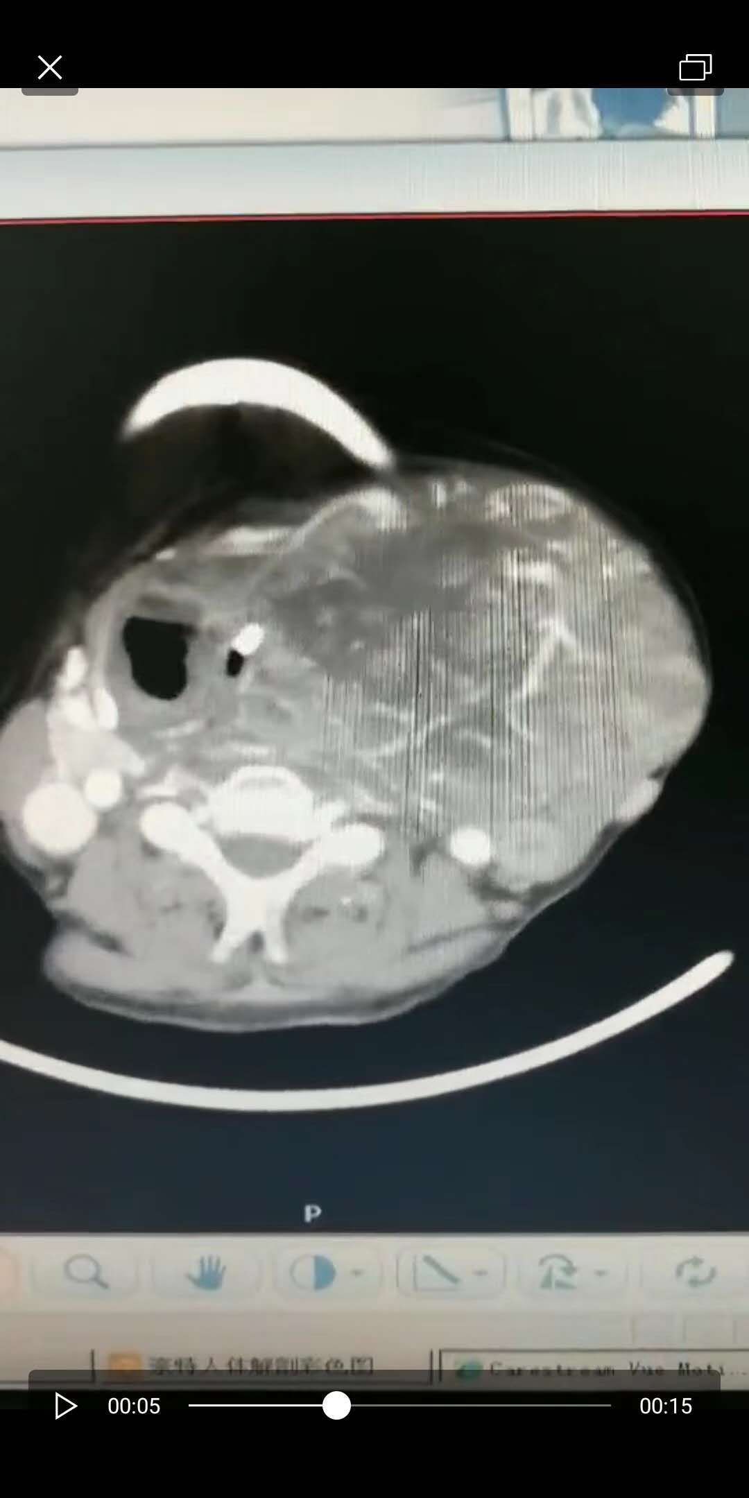 甲状腺癌ct表现图片