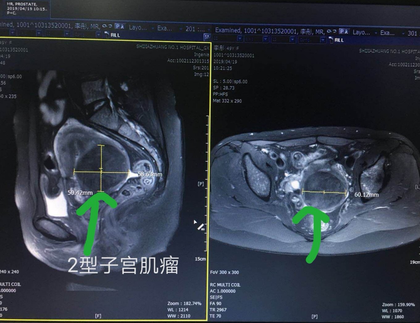 子宮肌瘤分型圖片王宏衛主任出診時間和地點石家莊市人民醫院 範西路