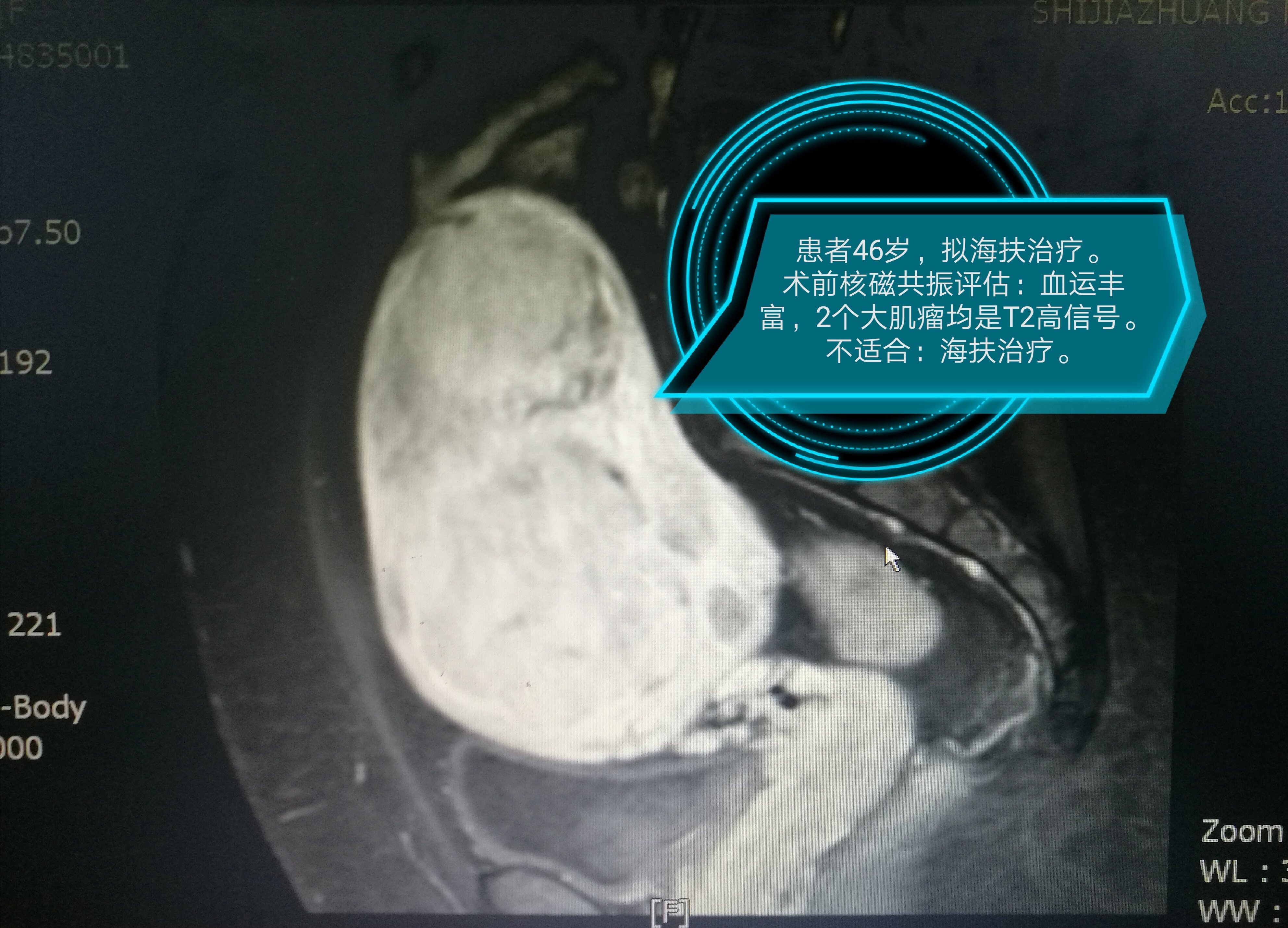 子宫肌瘤做海扶治疗前为什么要做核磁共振检查