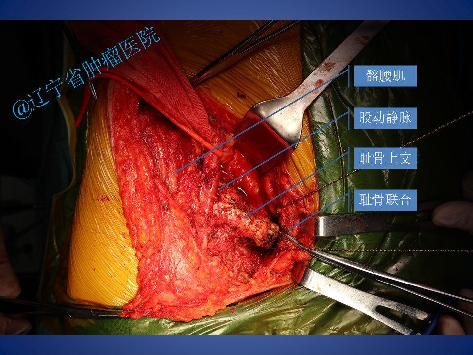 骨盆耻骨肿瘤切除手术病例 - 好大夫在线
