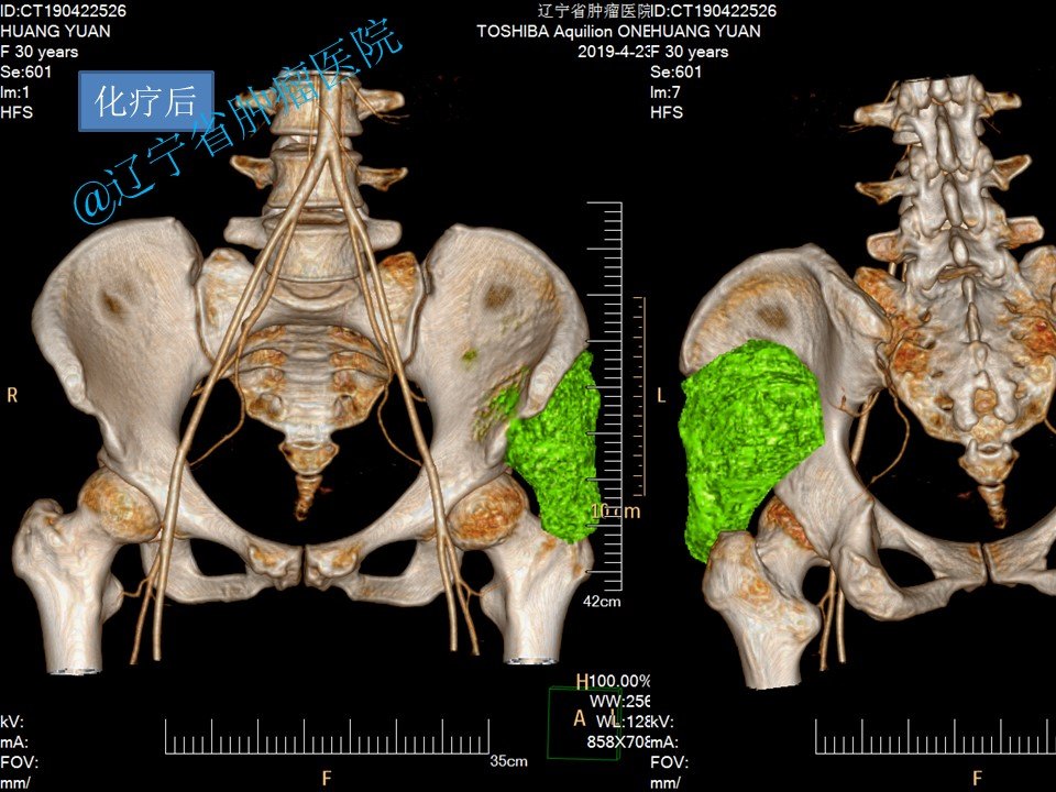 右侧髂骨 www.haodf.com