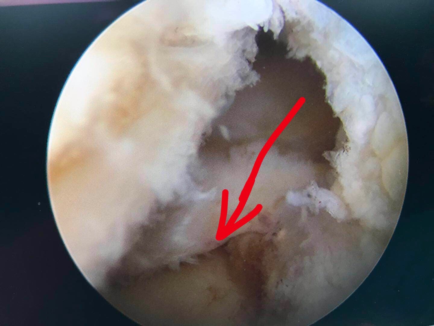 予以部分切除成形術;圖2外側盤狀半月板圖1是膝關節內側滑膜皺襞,會