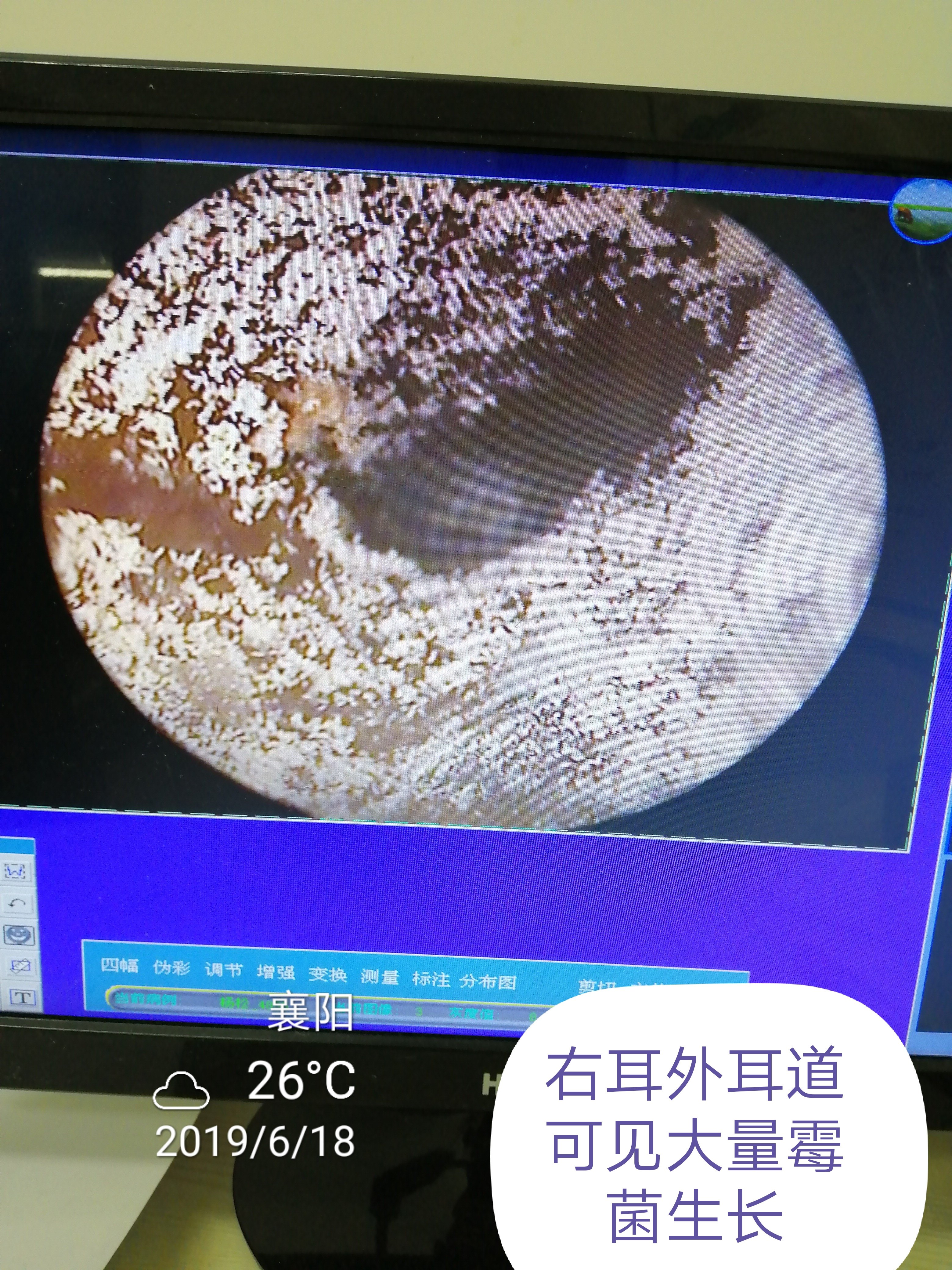 真菌性外耳道炎如何治疗 外耳道真菌病 病因 症状 治疗方法 预防 真菌性外耳道炎如何治疗 外耳道真菌病 病因 症状 治疗方法 预防