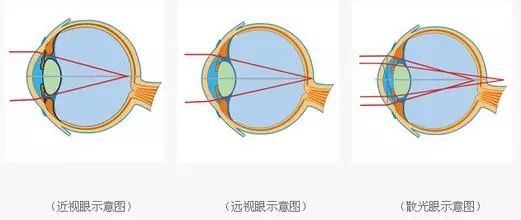 儿童散瞳药你选对了吗