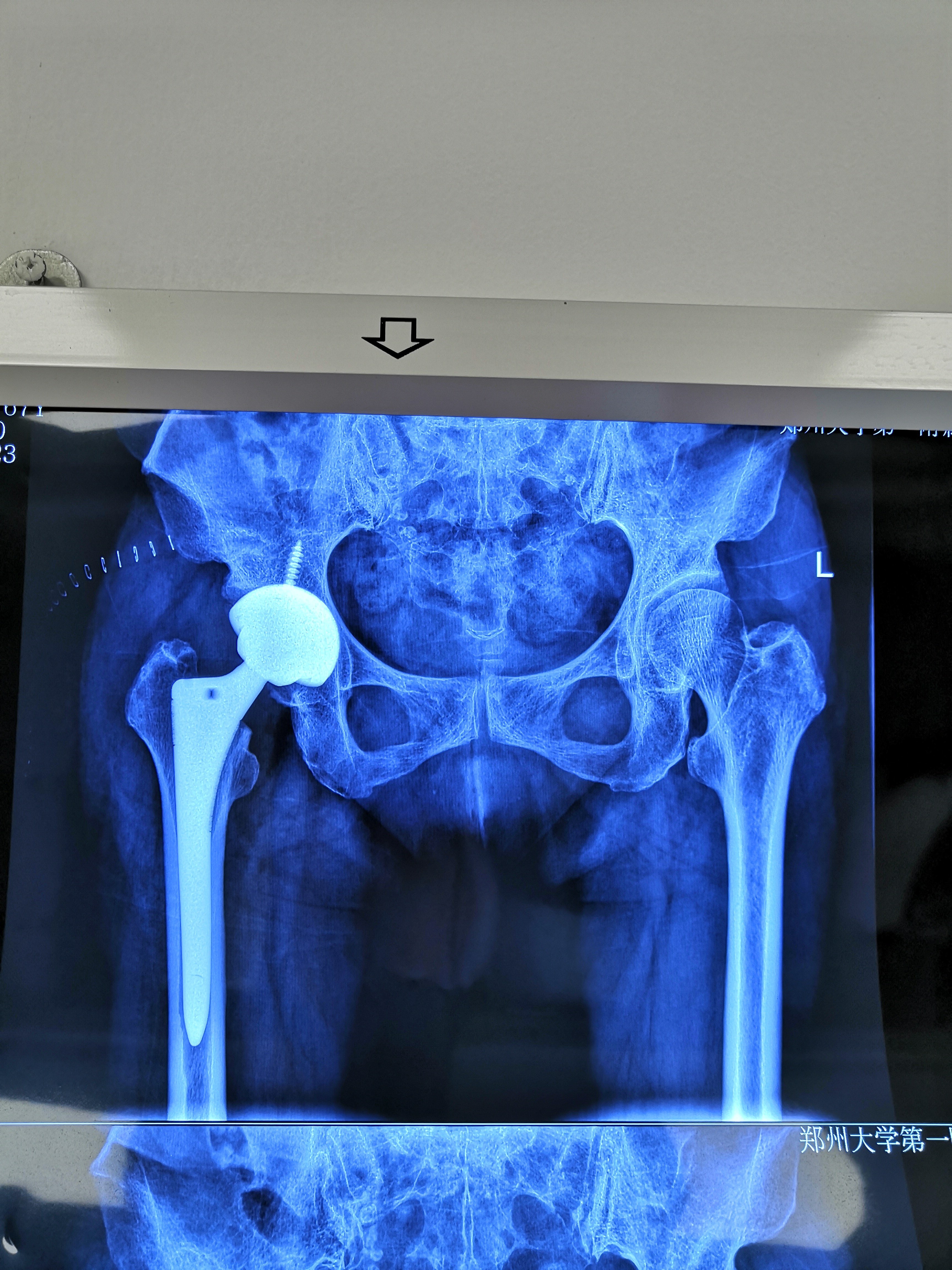 一例股骨头坏死术前术后对比