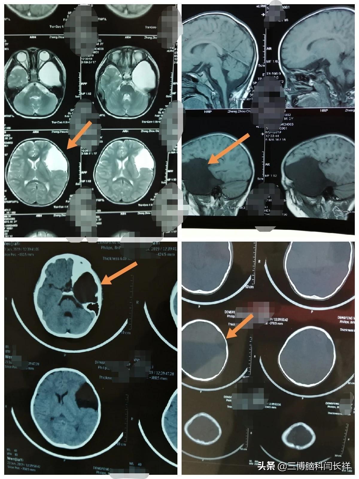 意外发现孩子的蛛网膜囊肿到底要不要治疗