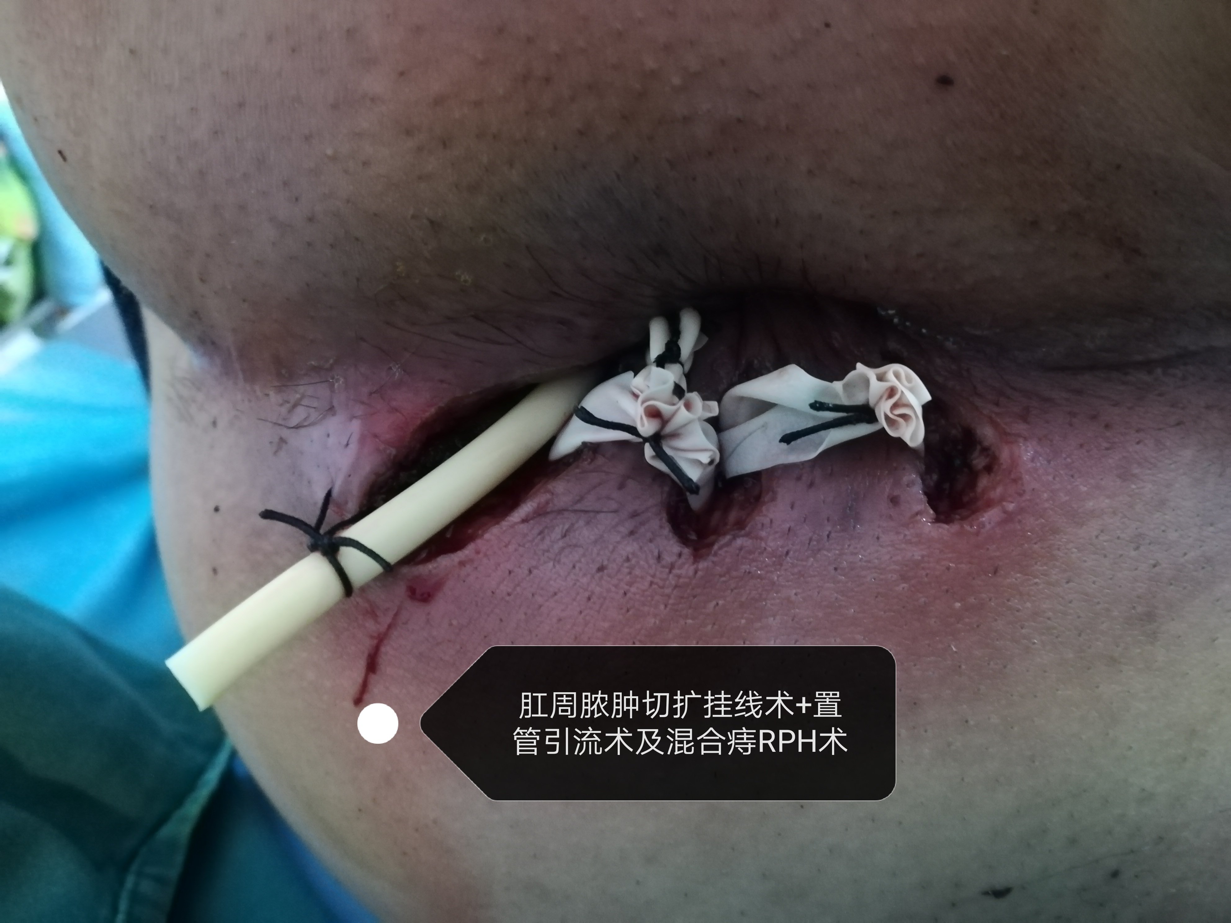 重视肛门肿痛