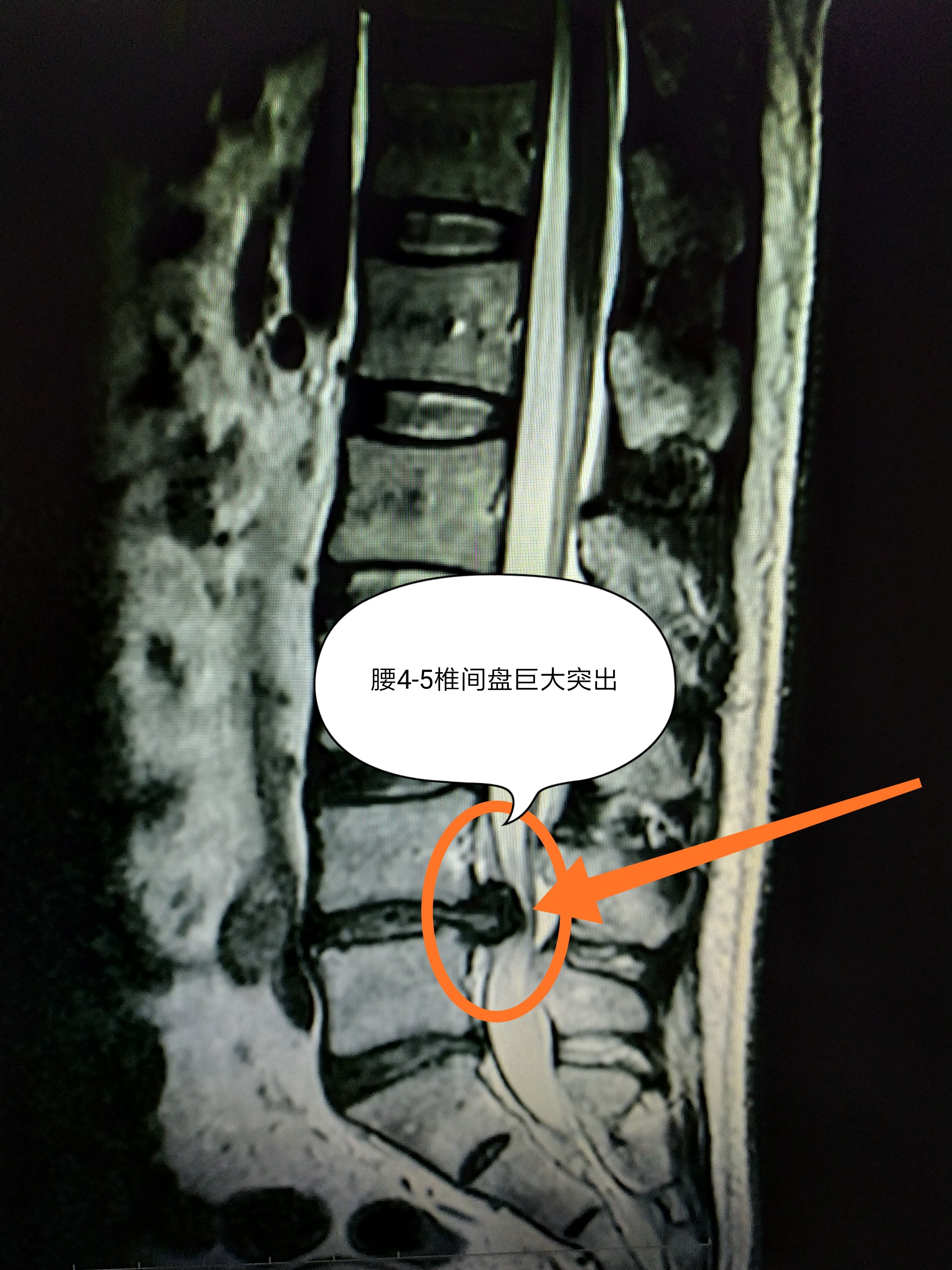 李明(化名),男,28歲,因為體檢查腰椎ct或核磁(mri)發現腰椎間盤突出