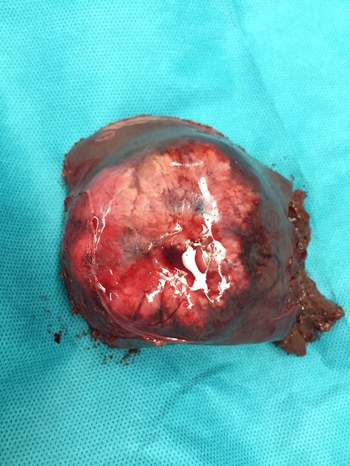 肝肿瘤图片 初期图片