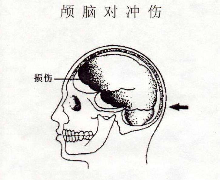 病人是一個典型的對沖傷,也就是後枕部著地,而額葉和顳葉存下斑點樣的