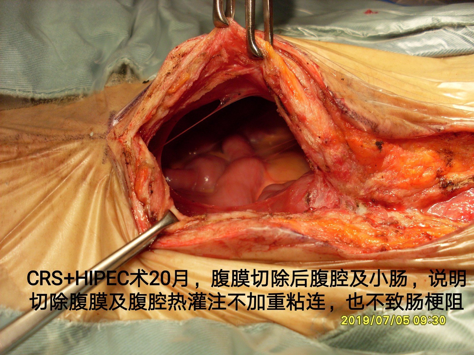 病例90卵巢首發pmp實為闌尾來源3次手術4年半後不全腸梗阻