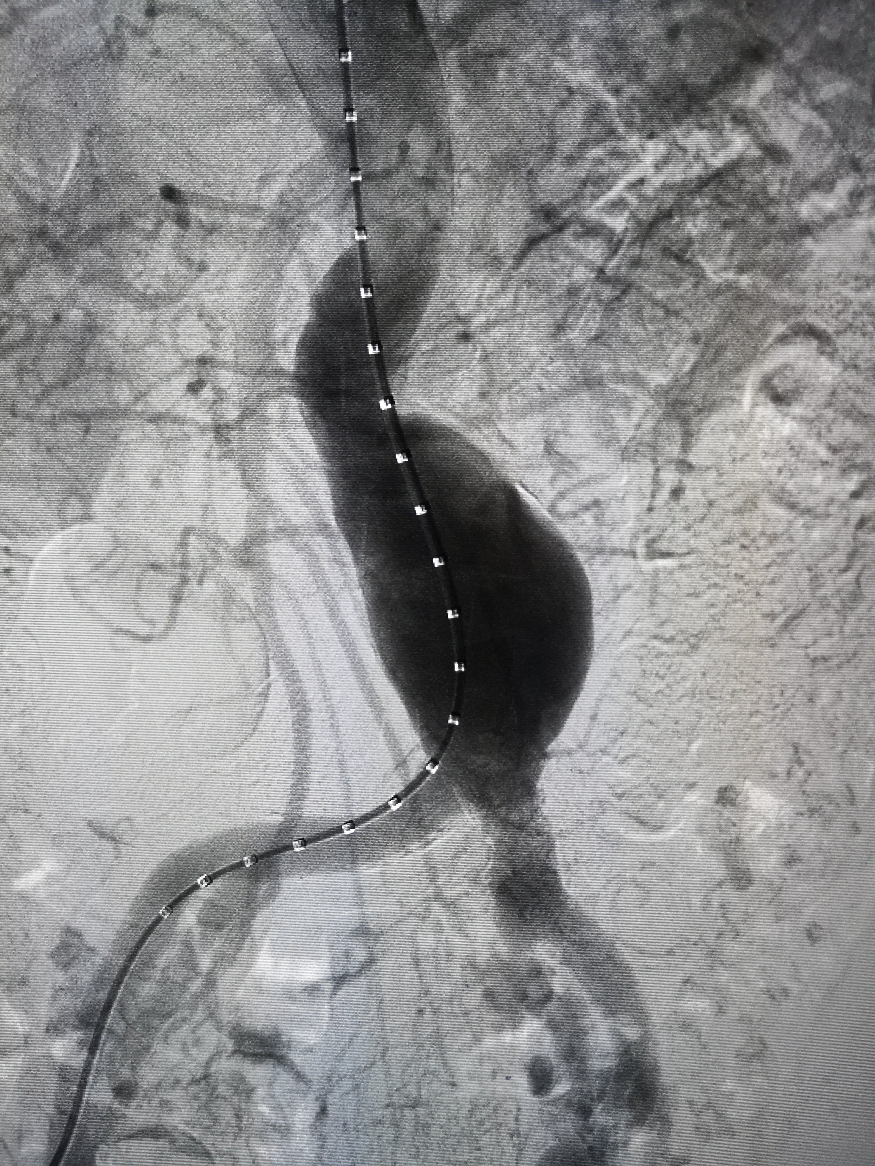 主动脉造影可见动脉瘤瘤样扩张,体内不定时炸弹支架植入隔绝主动脉瘤