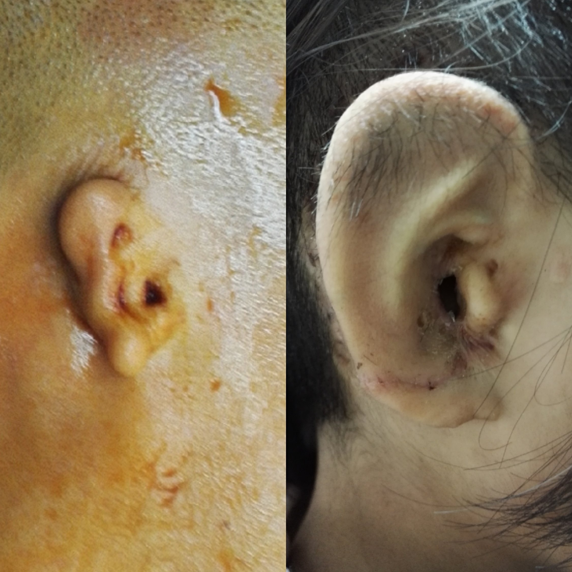 耳廓形态异常和耳廓结构异常的干预时间