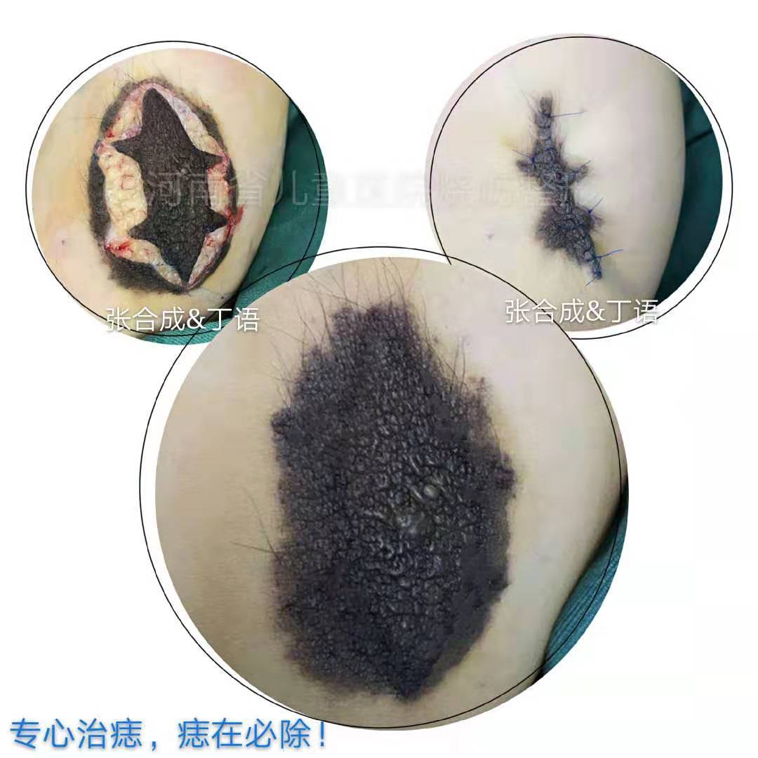 儿童先天性黑痣(包括巨痣)的有关问题?_治疗方法 - 好大夫在线