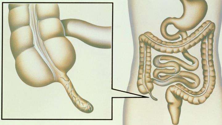 阑尾解剖位置6种图片