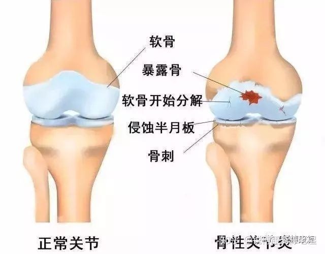 膝關節疼痛打玻璃酸鈉到底好不好