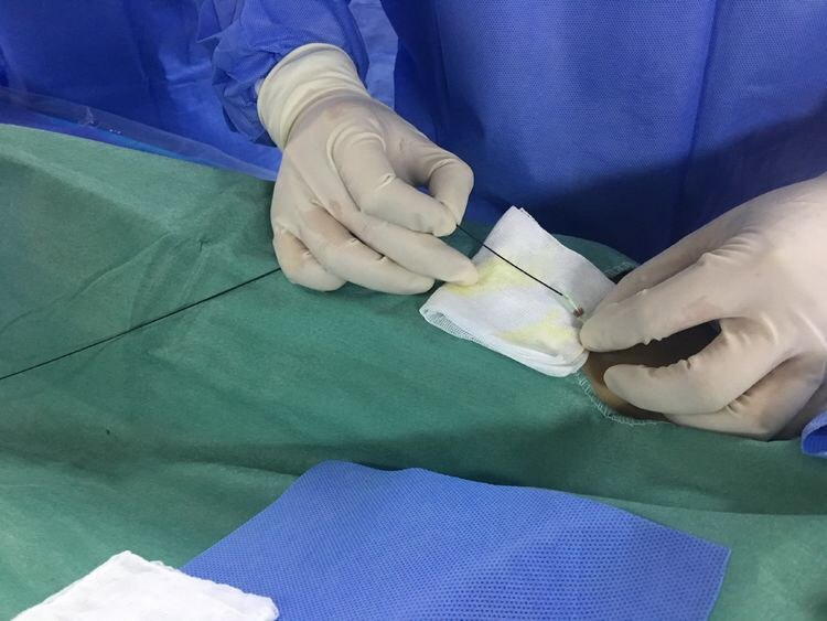 子宫腺肌症合并肌瘤介入手术治疗病例分享_子宫腺肌症_介入治疗_治疗