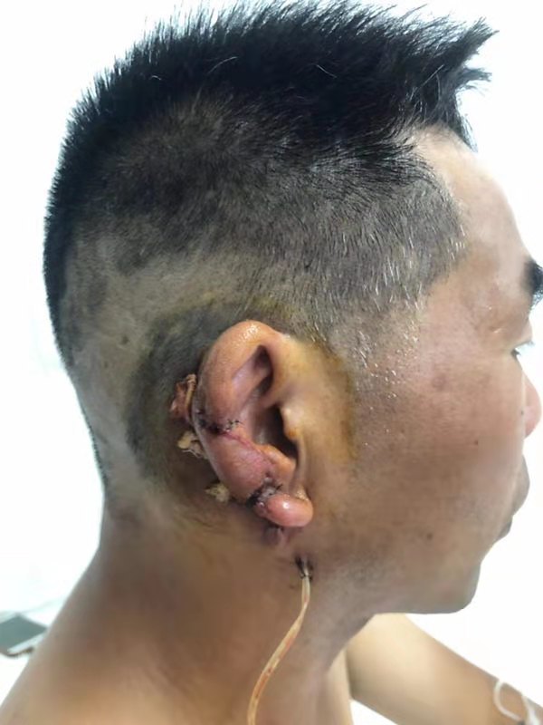 耳外伤后部分再造