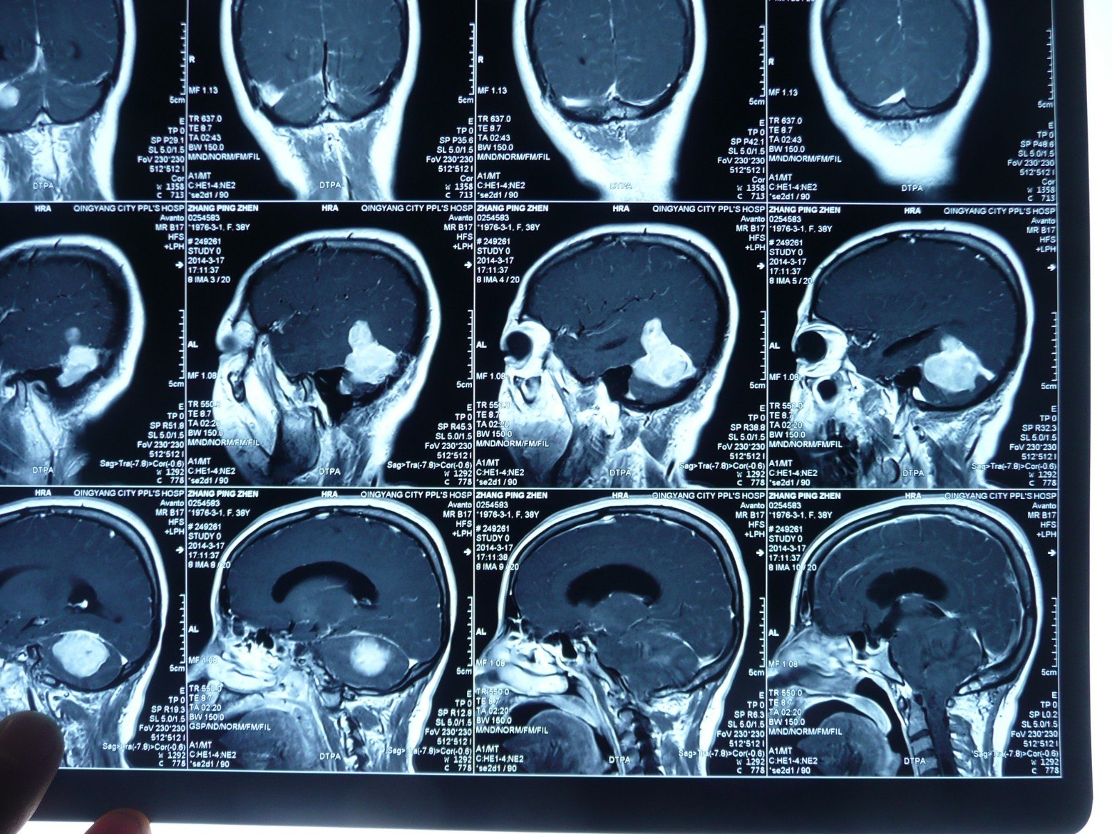 贺晓生教授小脑幕上下骑跨脑膜瘤的外科切除手术案例 - 好大夫在线