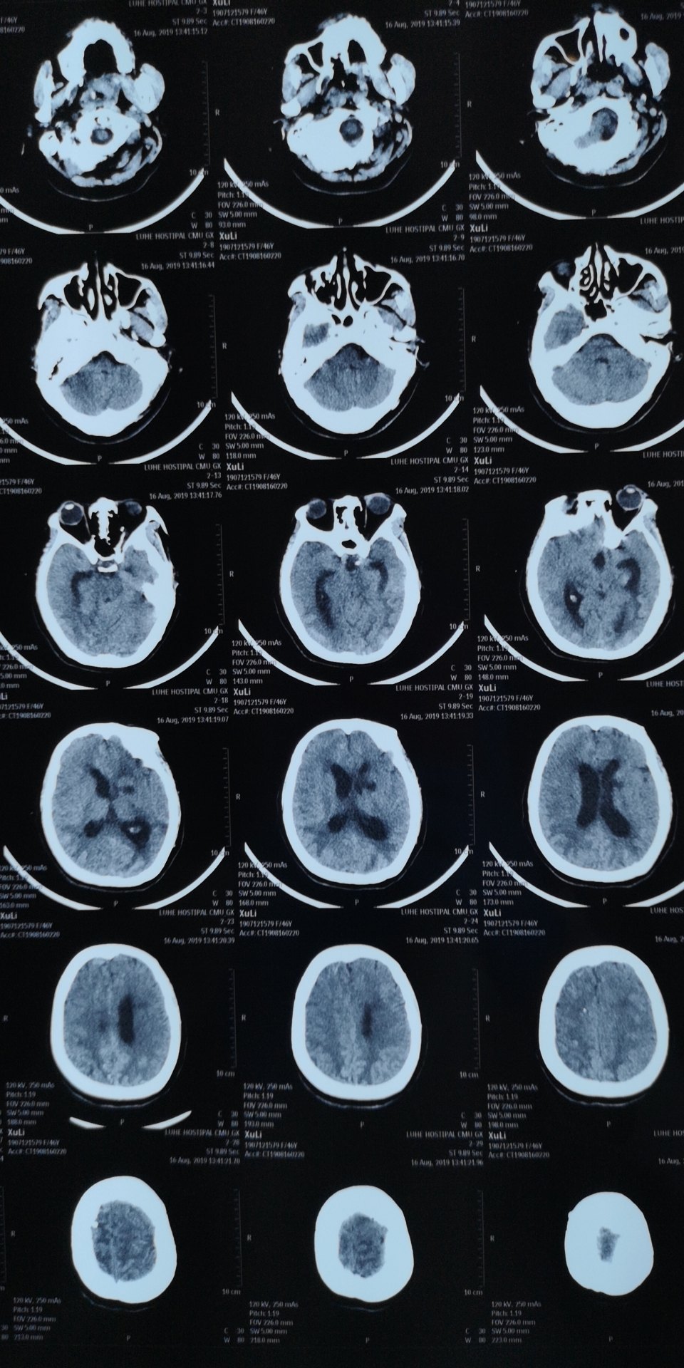 脑出血后大面积脑梗塞雪上加霜怎么办