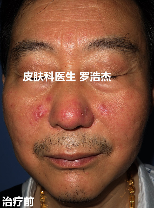 酒渣鼻玫瑰痤疮中医辨证治疗案例