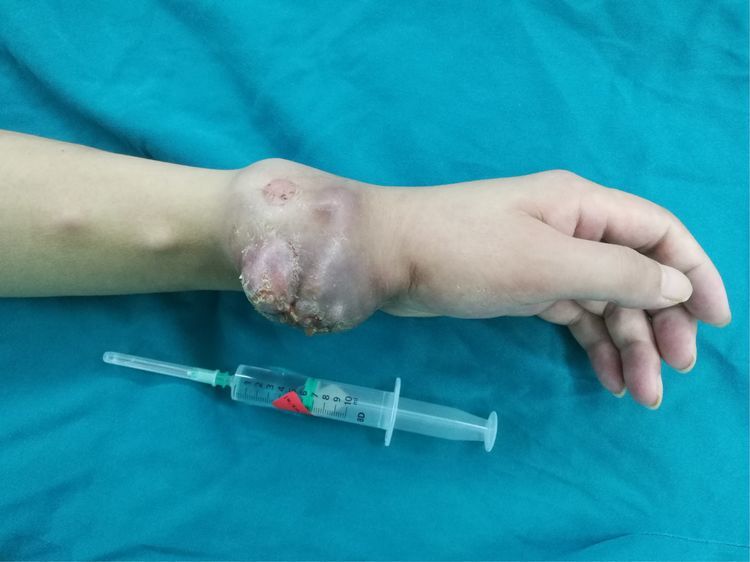 骨软组织肿瘤实战纪要--皮瓣篇,从带蒂到游离,我们一直在行动!