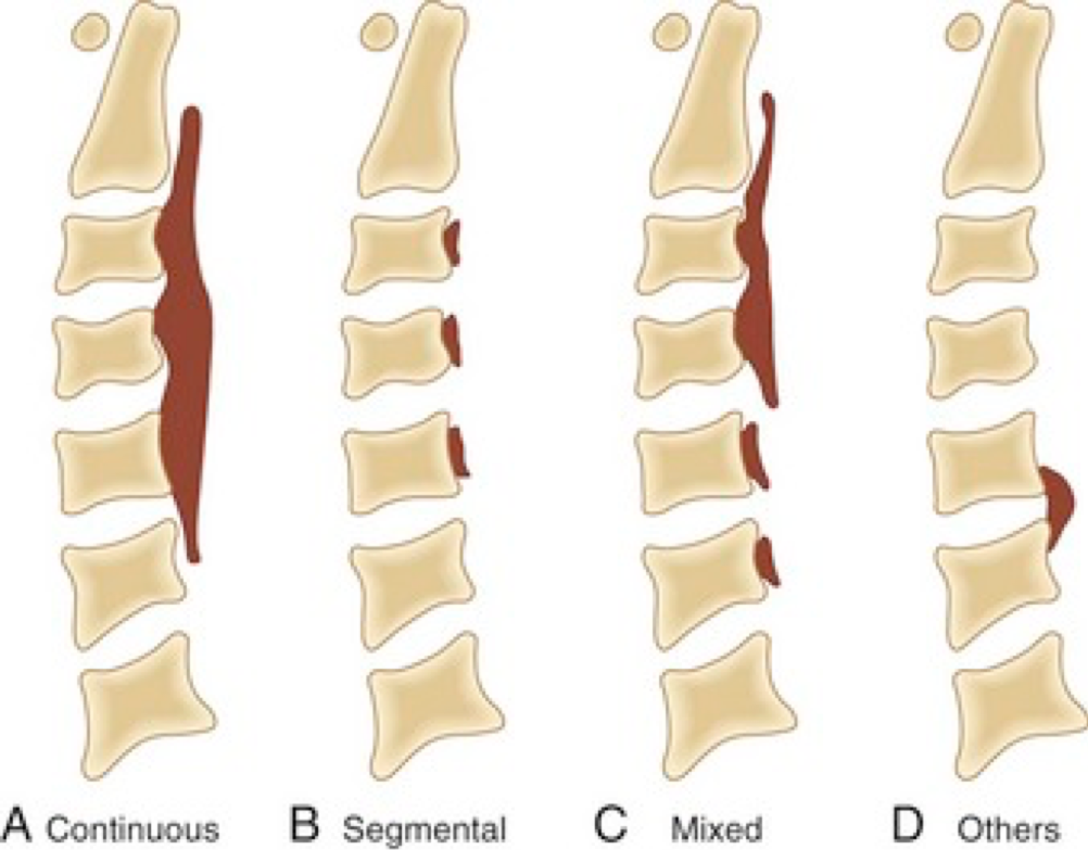 颈椎后纵韧带骨化症(opll)是什么,哪些人容易得,如何治疗?