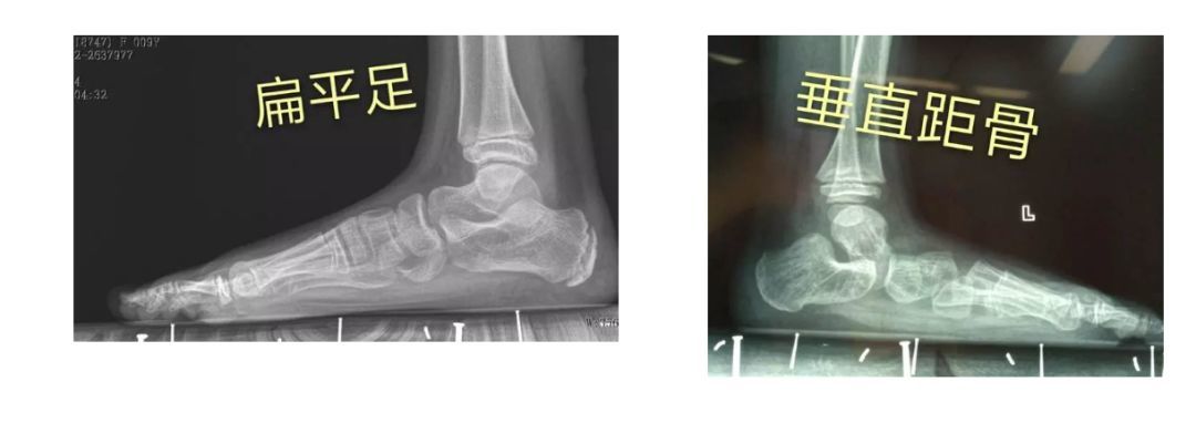 扁平足和僵硬性扁平足,需要儿童骨科医师仔细鉴别检查,特别是垂直距骨