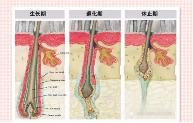 停止血液供应导致会毛囊萎缩,其毛发也从强壮的终毛萎缩成弱小的毫毛