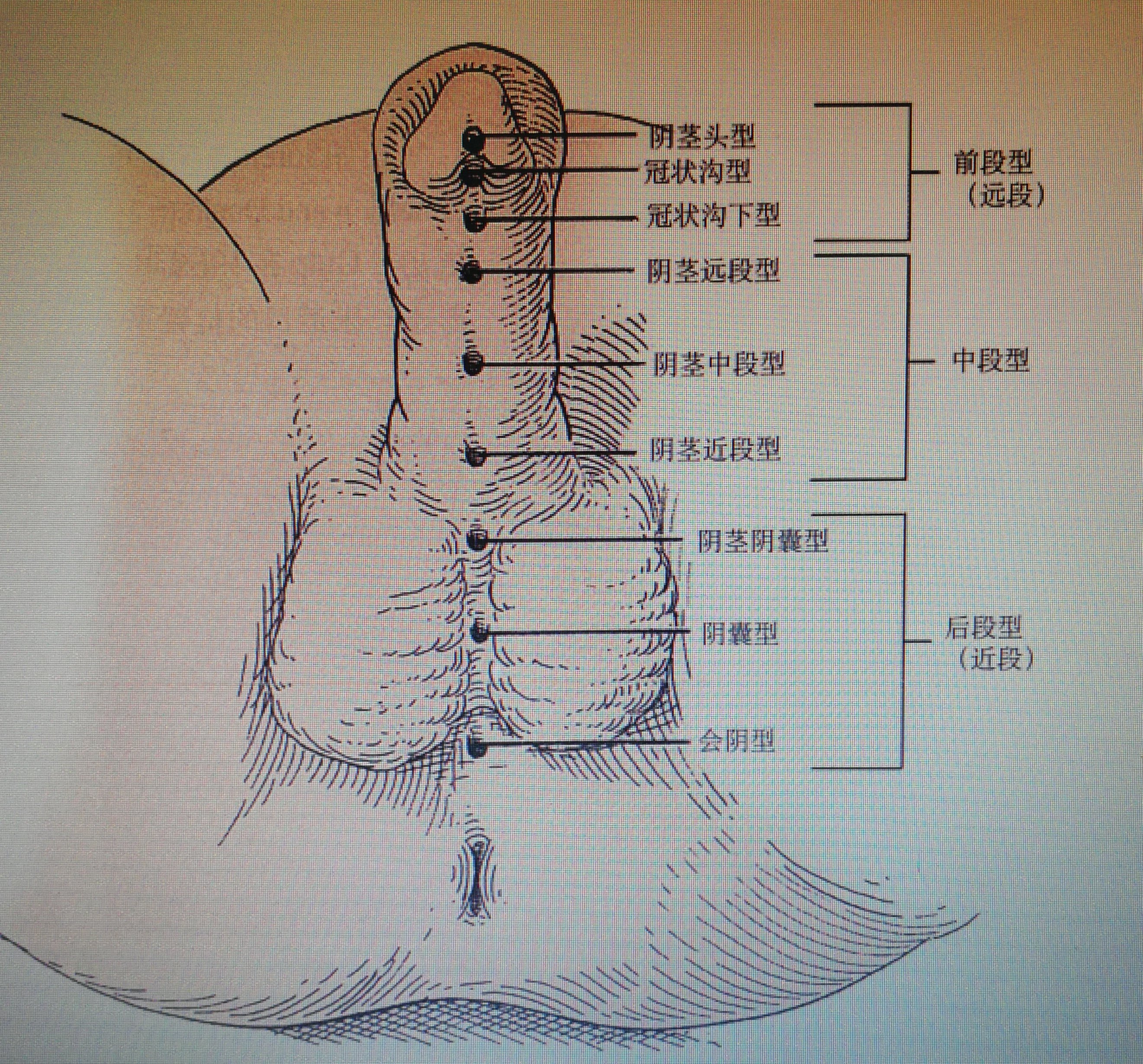 尿道下裂分型的图片图片