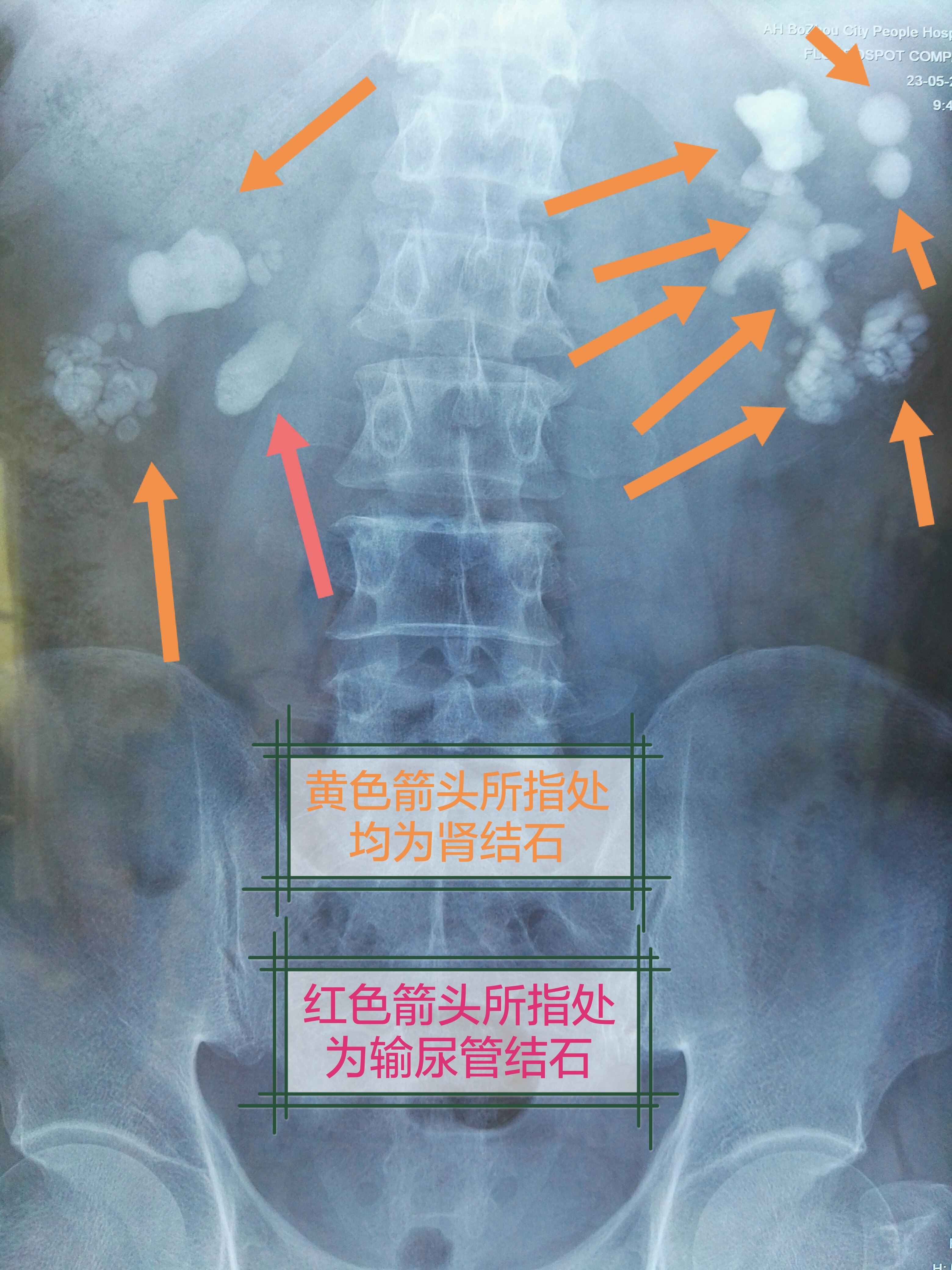 肾结石如何治疗