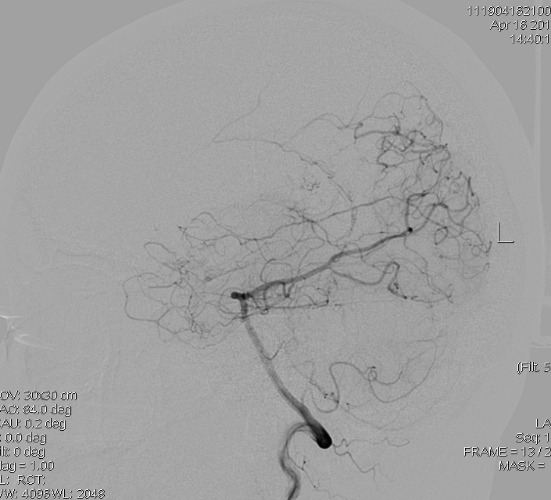 煙霧病行顳淺動脈大腦中動脈搭橋一例