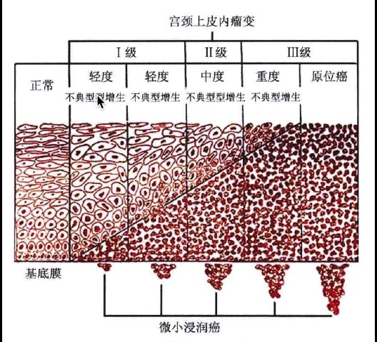 各种宫颈上皮内瘤变都如何治疗 宫颈癌前病变