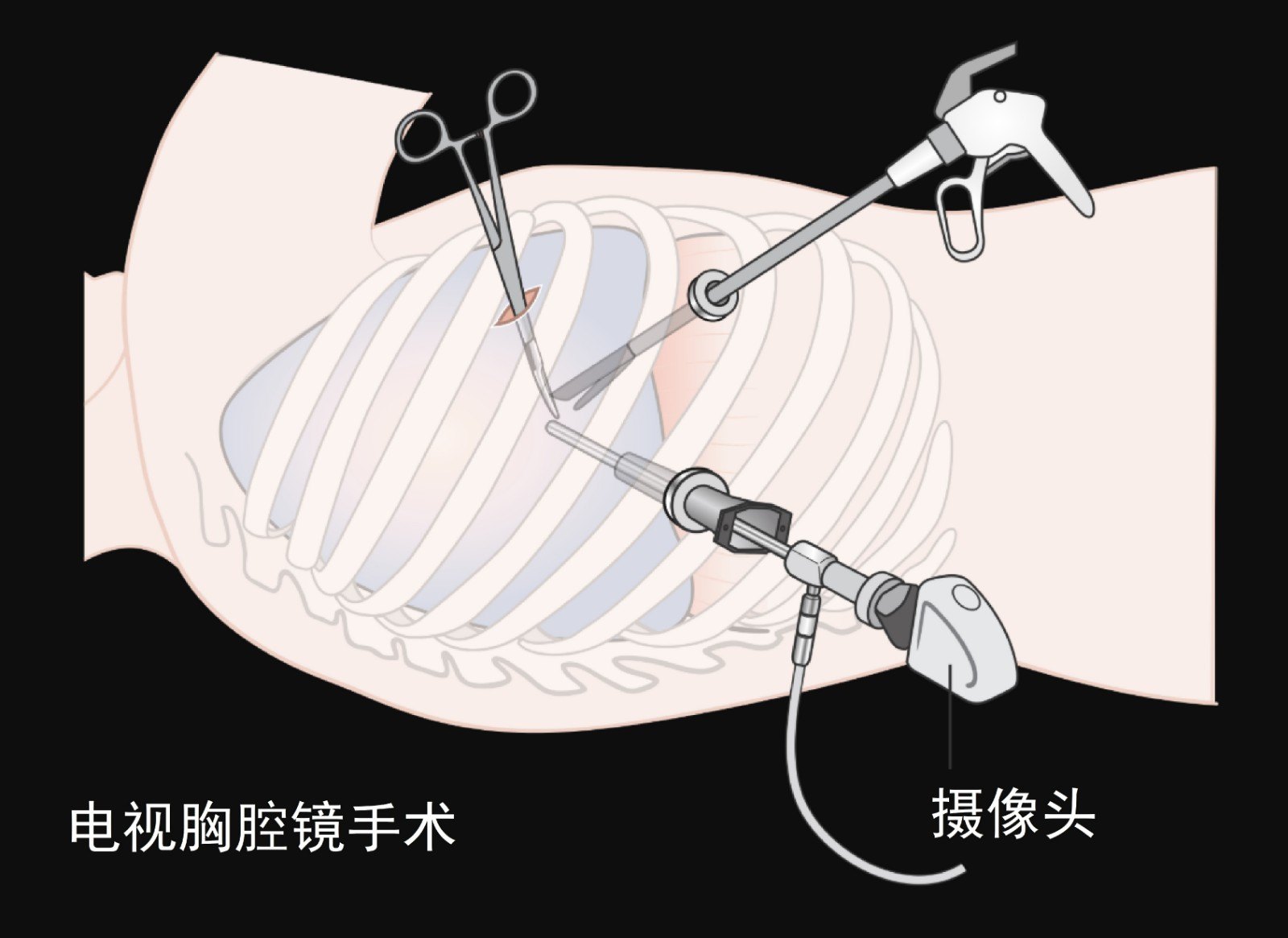 气胸胸腔镜手术过程图片