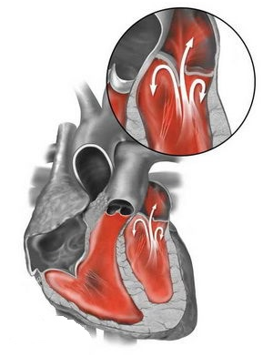 二尖瓣退行性病变的瓣膜成形_二尖瓣关闭不全_手术_病因 - 好大夫在线