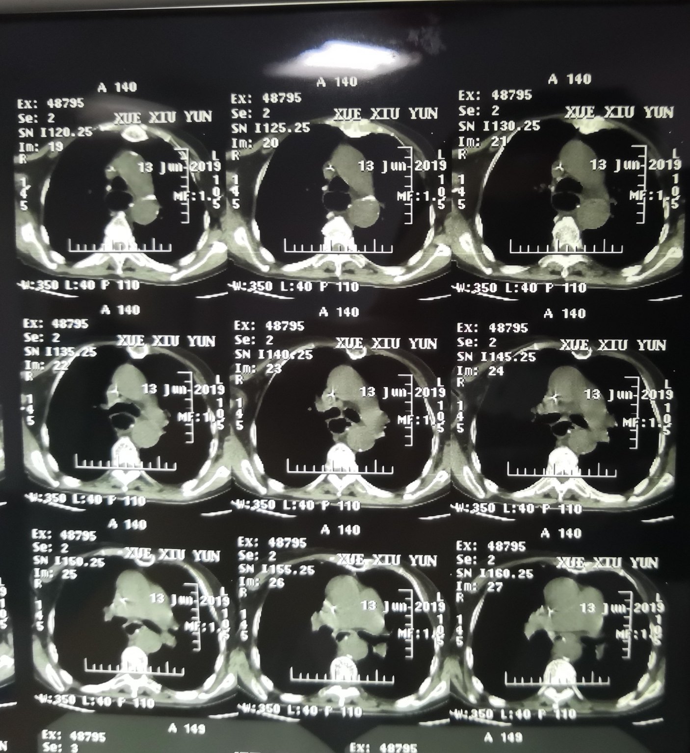 哈医大二院胸外科经典病例之胸腔管状胃 - 好大夫在线